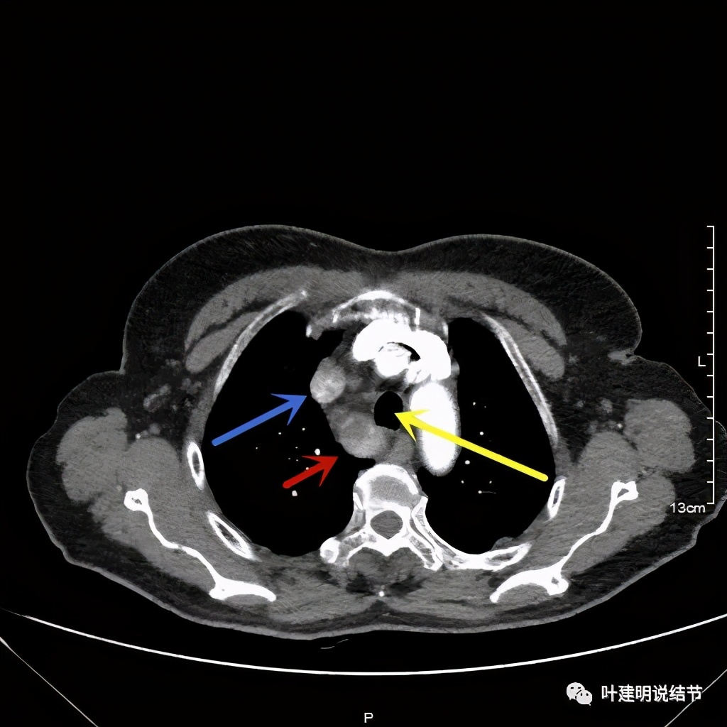 胸部高分辨ct检查注意事项,胸部ct扫描有没有危害