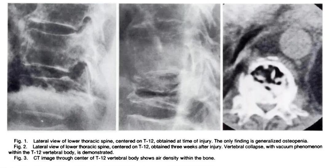 创伤后的右侧颞叶脑出血多久可好,创伤后综合征能恢复吗
