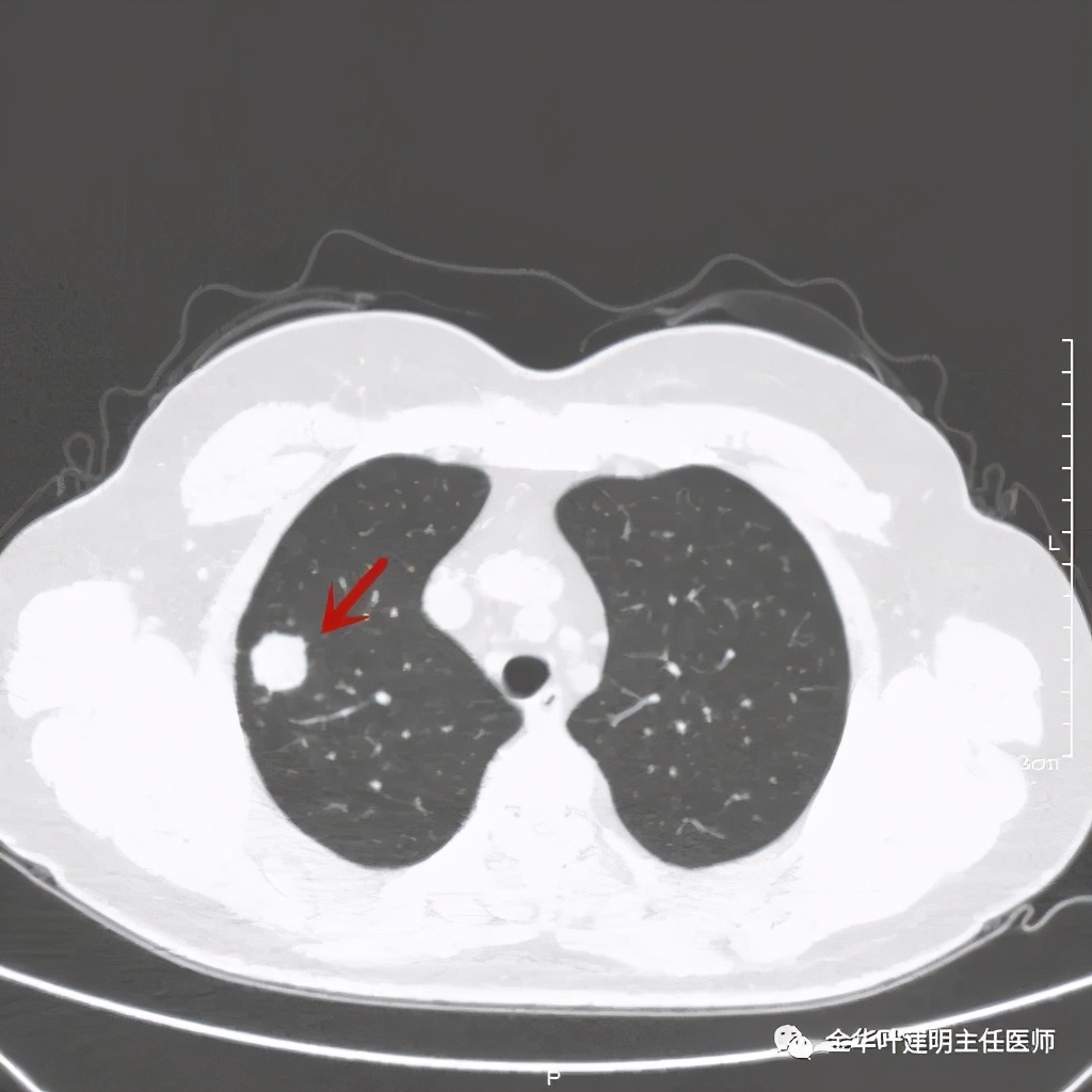右上肺结节灶一般是什么癌,右上肺恶性肿瘤是肺癌吗