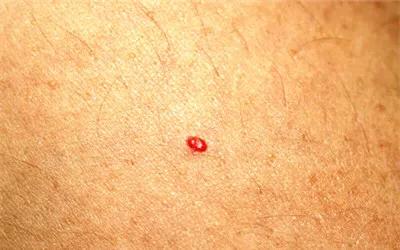 身上长细细的小红疙瘩是为什么,身上长七八个小红疙瘩是怎么回事