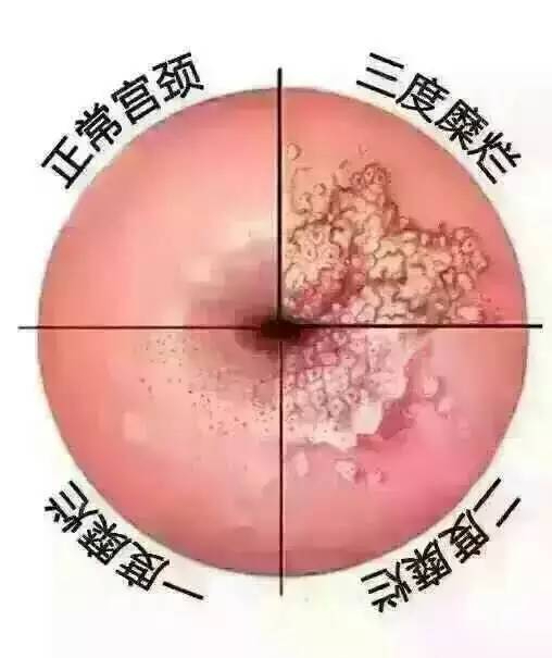 有宫颈糜烂慢性炎症容易生女孩吗,宫颈糜烂未生育的女性会得吗