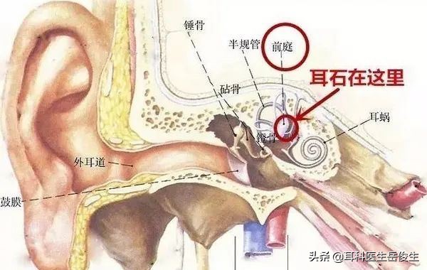 耳石症眩晕需要住院吗,耳石症必须住院吗