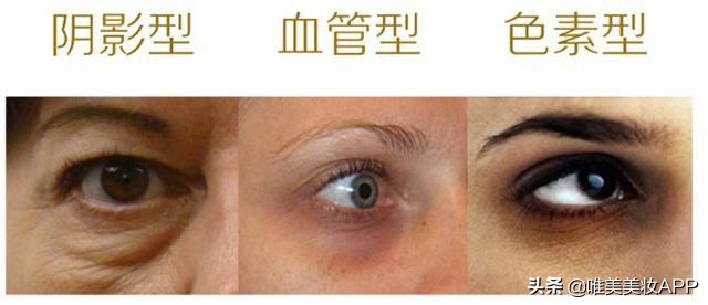 最常见的2种黑眼圈你中招了吗,黑眼圈分三种你都知道吗