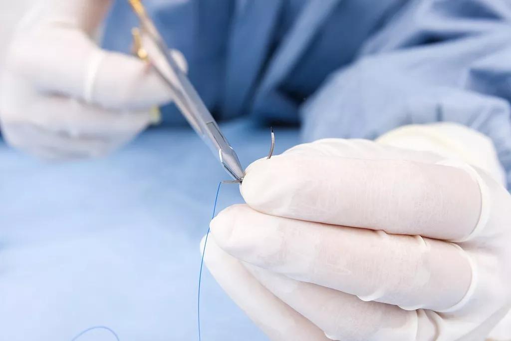 外科缝线知多少？这篇文章讲全了
