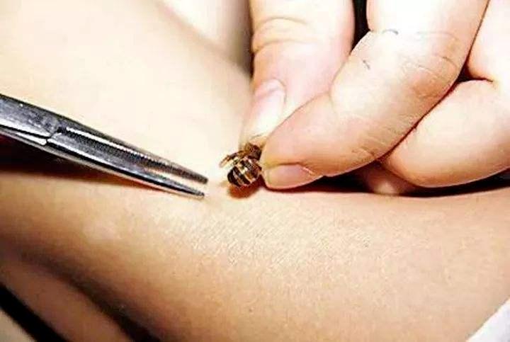 春游被蚊虫咬了怎么办,五一踏青小心毒虫叮咬