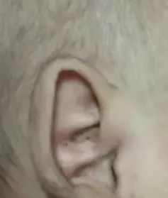 出生宝宝耳朵耳廓畸形判断,新生婴儿耳廓畸形圆耳