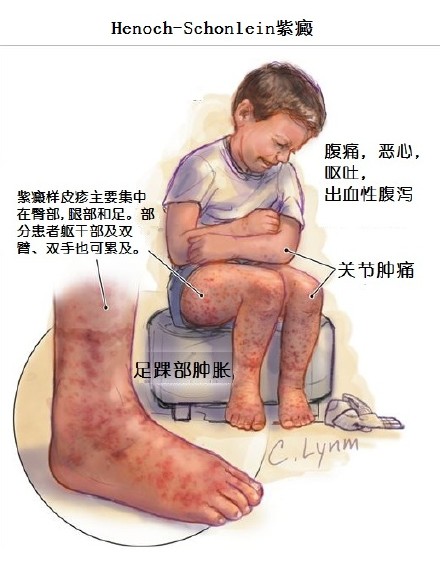 中西医结合治过敏性紫癜最好专家,中西医结合儿科过敏性紫癜