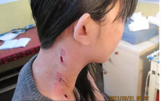 淋巴结核怎么治疗能彻底根除掉,淋巴结结核复发能不能彻底治愈