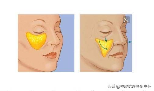 内窥镜小切口面部除皱术多少钱,微创内窥镜除皱副作用