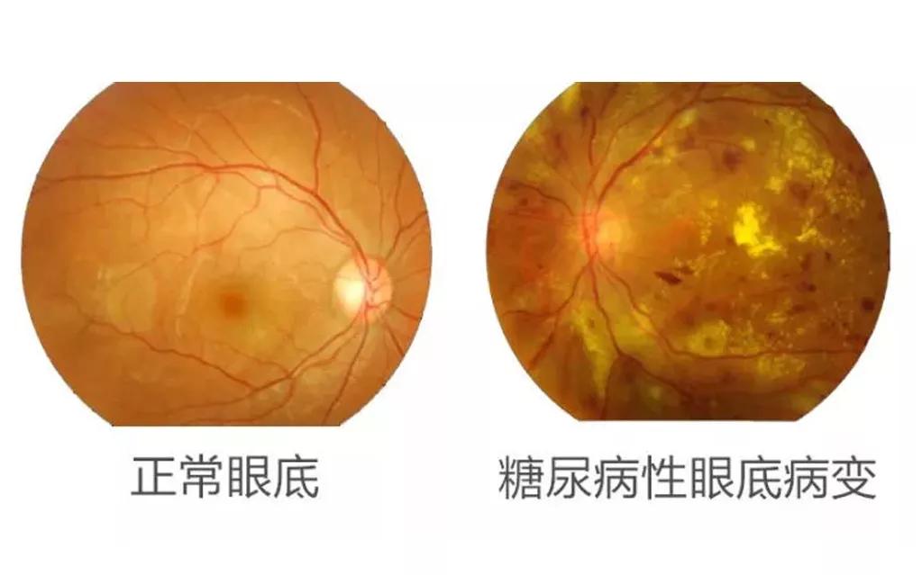 因糖尿病导致的失明怎么诊断,糖尿病眼瞎早期的症状是什么