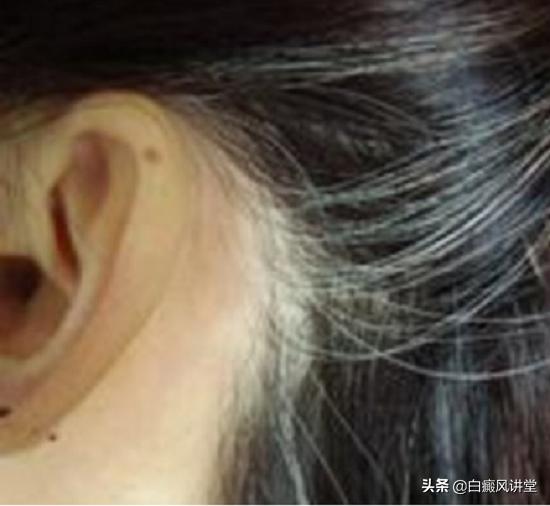 无色素痣白斑毛发会变白吗,腋窝有白斑毛发变白什么原因
