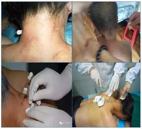 颈椎病三招搞定,几招搞定颈椎病