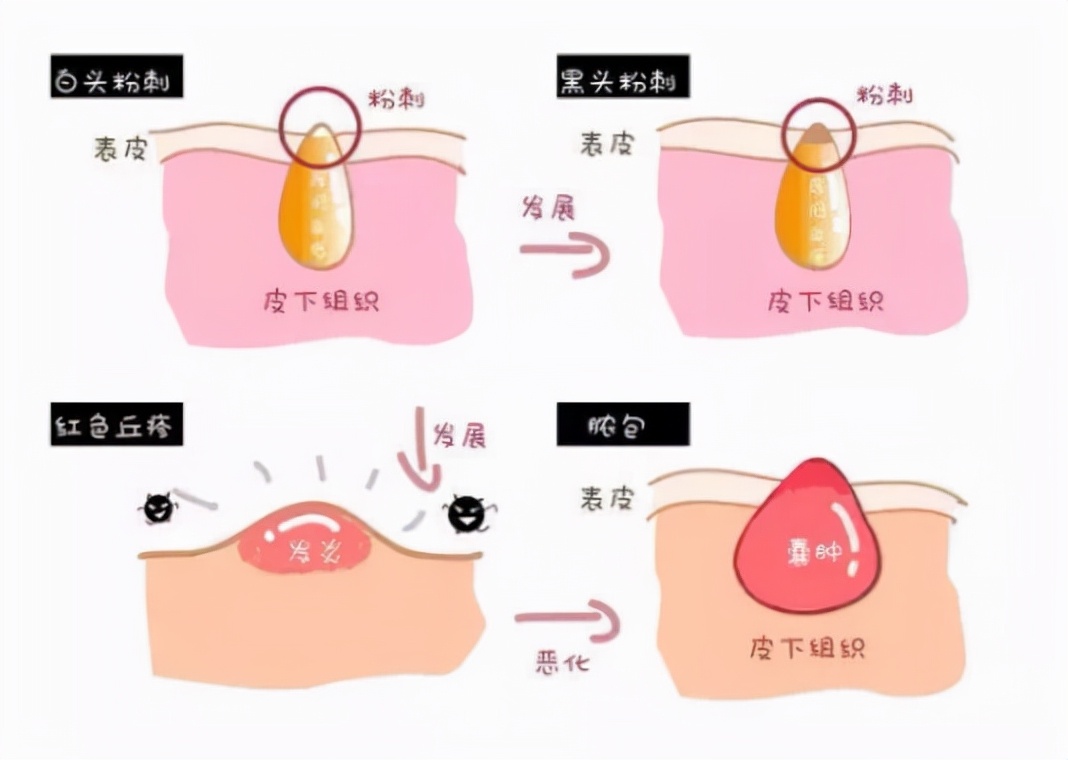 闭口剔除,闭口退红
