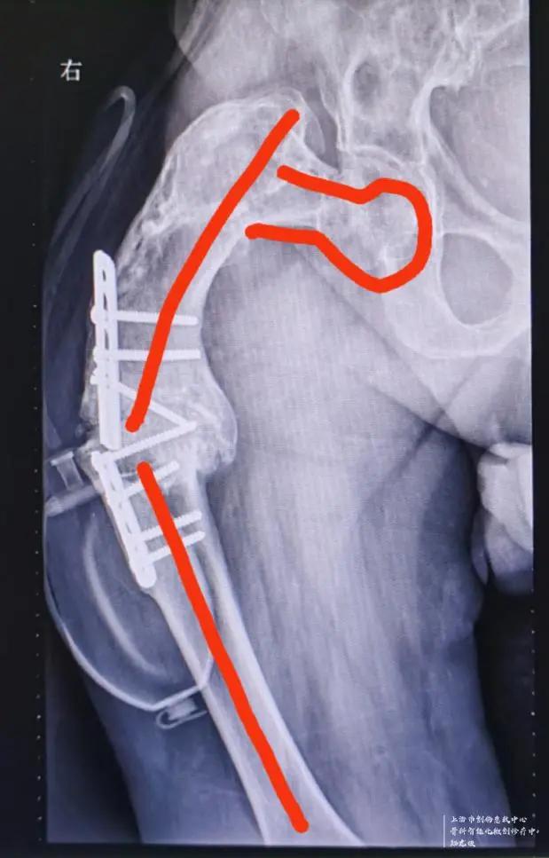 男子脚骨折去医院,男子脚伤手术后仍一瘸一拐