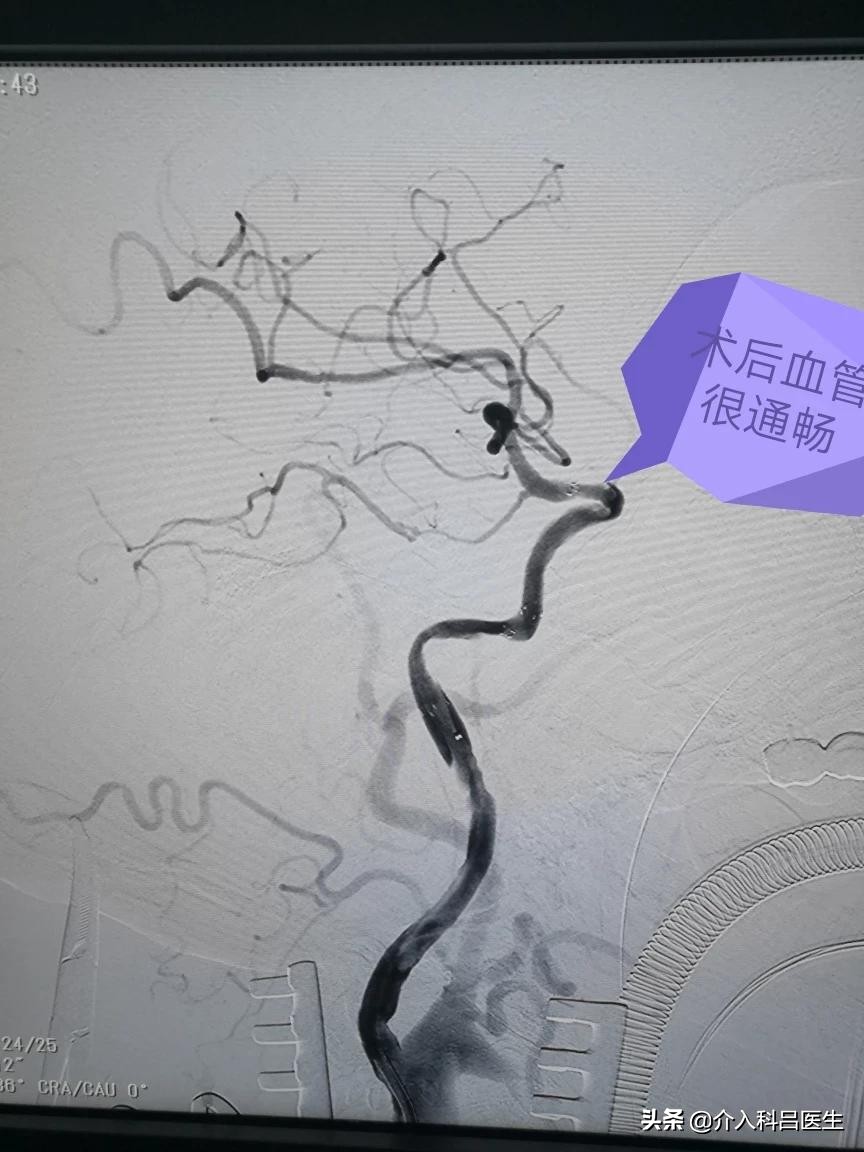 86岁左侧颈内动脉狭窄怎么办,75岁颈动脉狭窄81%咋样治疗