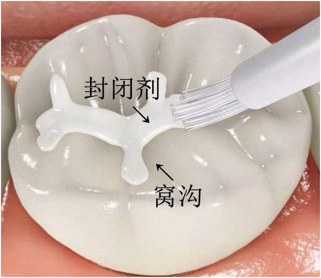 孩子蛀牙最简单有效的办法,宝贝蛀牙用什么牙膏