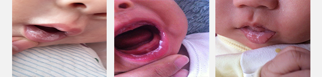 鹅口疮用了很多方法,反反复复怎么办?