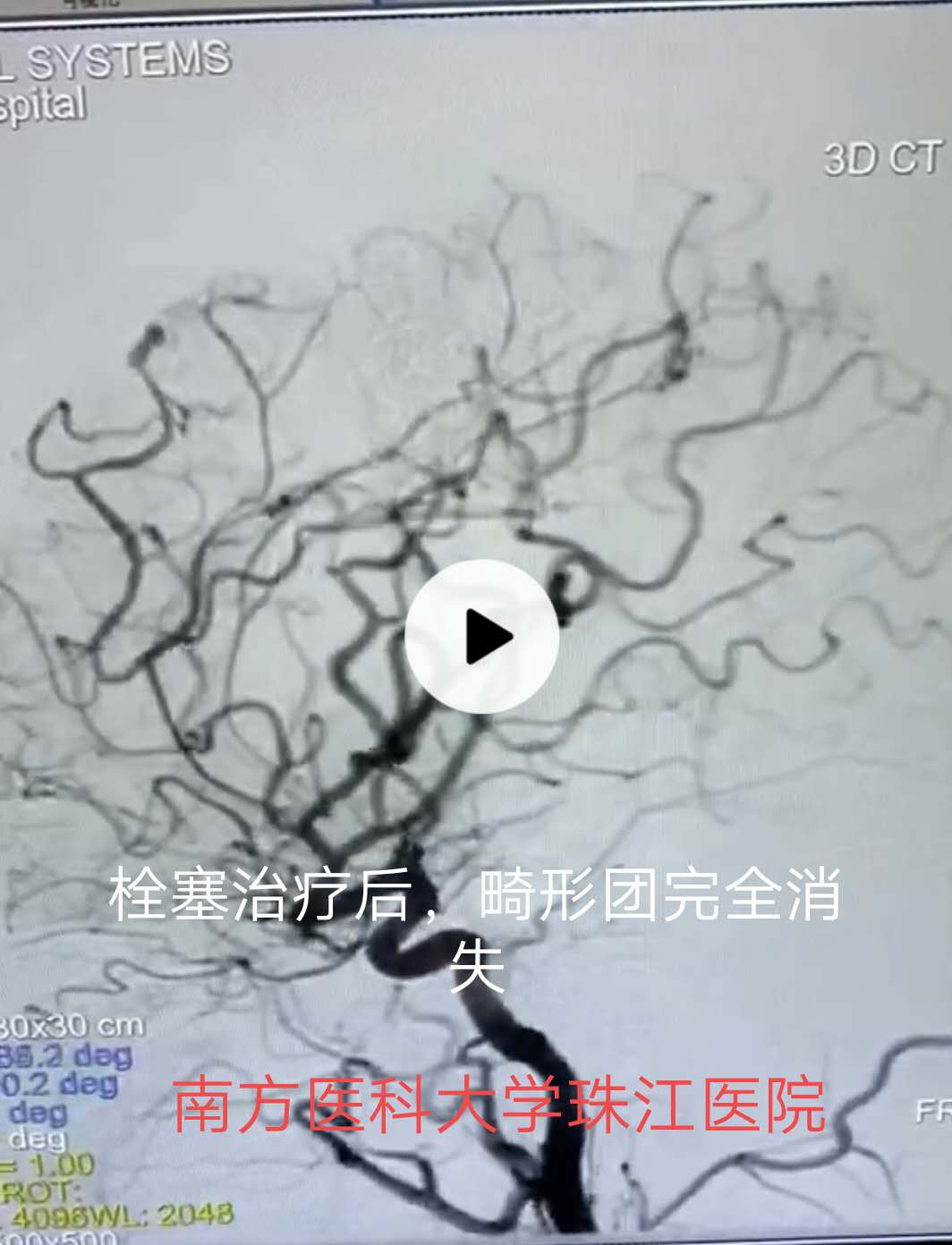 脑动静脉畸形可选用的栓塞物,脑动静脉畸形做伽玛刀后康复