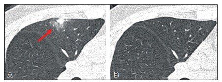 肺结节中的ggo代表什么,肺结节ggn与ggo有什么区别