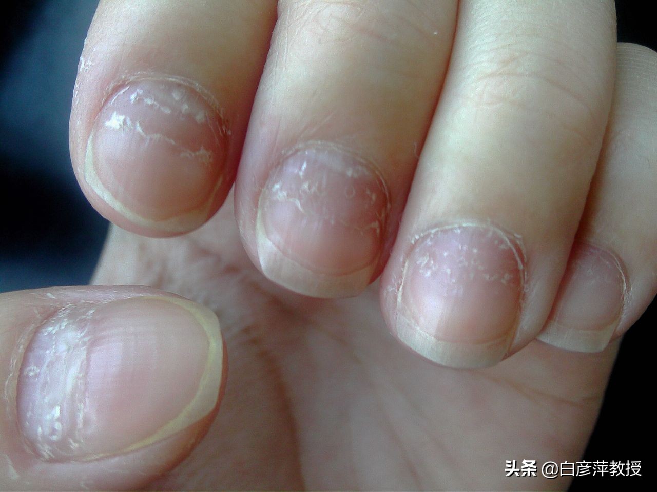 灰指甲是真菌怕晒吗,灰指甲一定是灰色的吗