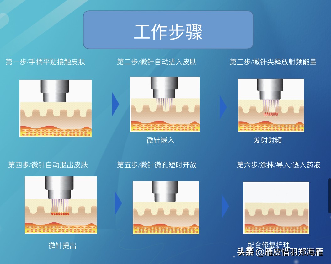 黄金微针眼部抗衰,黄金微针抗衰老的效果自然吗