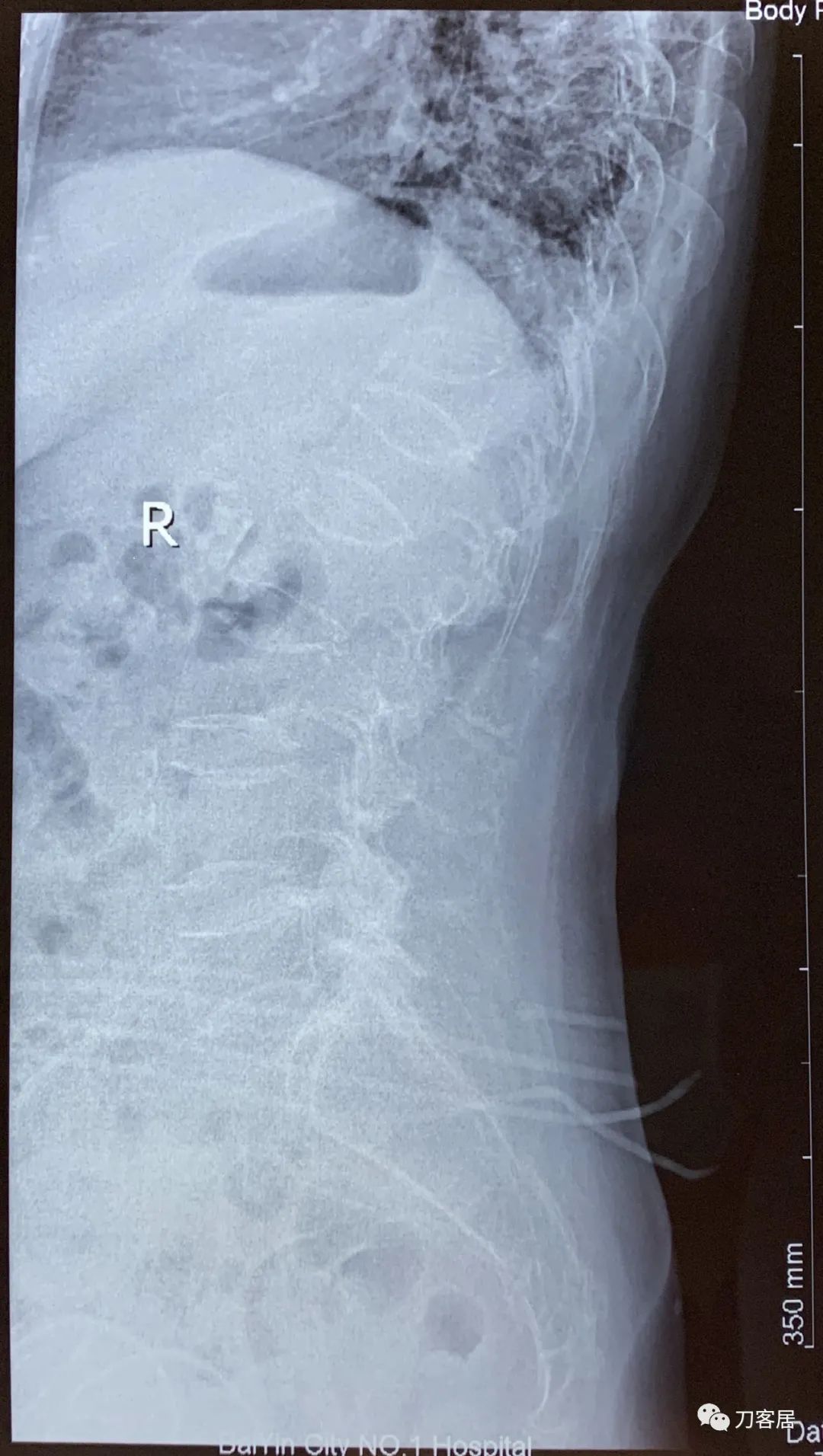 胸椎压缩性骨折病历,脊柱骨质疏松性压缩性骨折