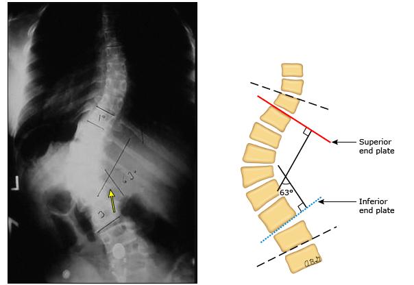 我国青少年脊柱侧弯占1%到2.7%,青少年脊柱侧弯40度矫正方法图解