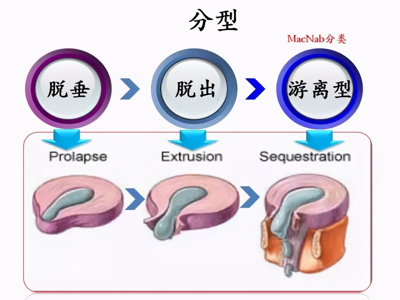 腰椎间盘突出手术后多久恢复正常,颈椎腰椎间盘突出最快的恢复办法