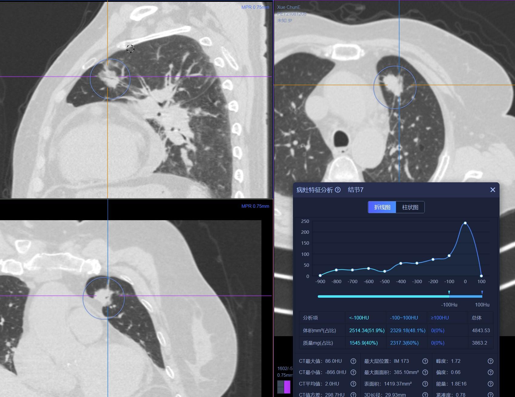 肺结节检查是薄层ct还是三维重建,肺结节检查用什么ct