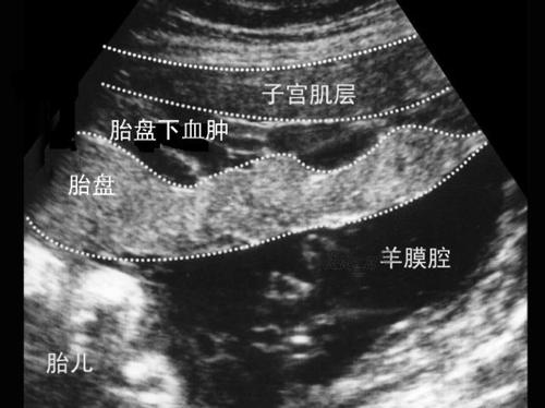 孕妇7个月被撞胎死腹中,女儿不小心撞到孕妇