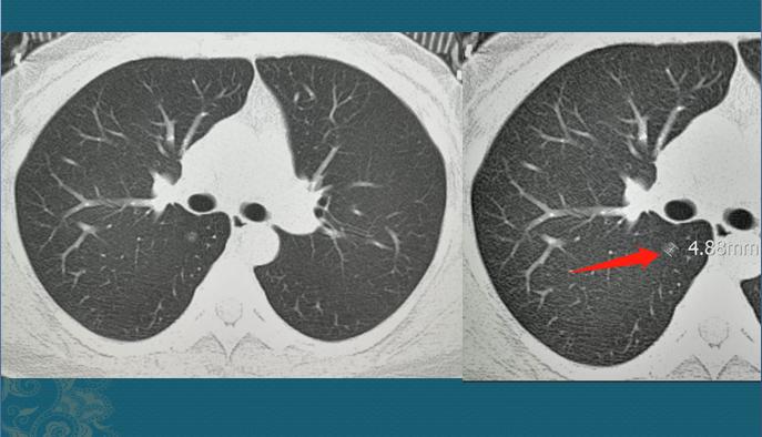 磨玻璃结节术后又长出2mm小结节,磨玻璃结节2mm基本上是癌