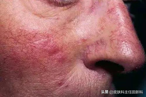 脸上成片斑是哪里出了问题,脸上痘印变成癣了怎么回事