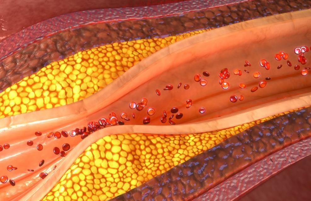 冠状动脉狭窄到什么程度需要支架,冠状动脉狭窄什么程度需要放支架