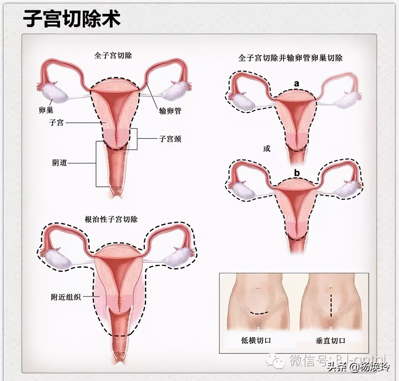 「科普」捍卫子宫，反对阉割，*制抵**新时代下切除子宫的酷刑
