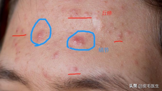 痘痘肌有效治理帮你轻松终结战痘,与痘痘和解与自己和解