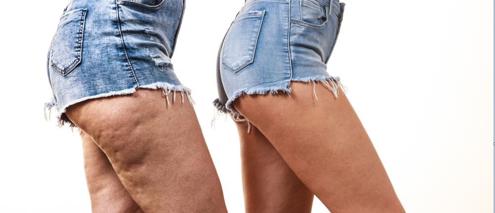 屁屁不红疼是怎么回事,屁屁凹凸不平如何改善