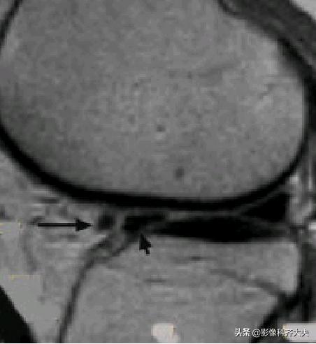 膝关节半月板损伤的磁共振,膝关节半月板病变的mri诊断与鉴别