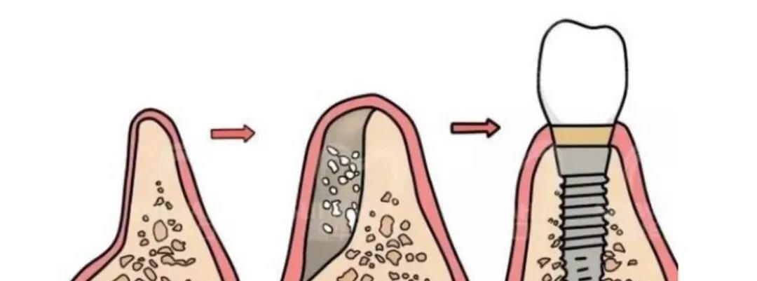 老年人牙槽骨萎缩,不能种牙?这一个办法可以拯救