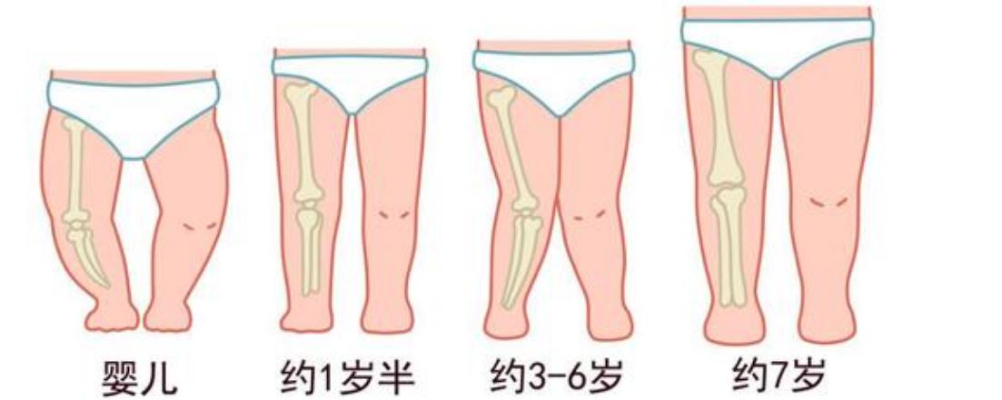 怎么判断宝宝腿型是否正常,宝宝腿型什么时候干预