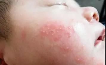 小孩皮疹湿疹水痘有什么区别,幼儿急疹出的疹子是水痘吗