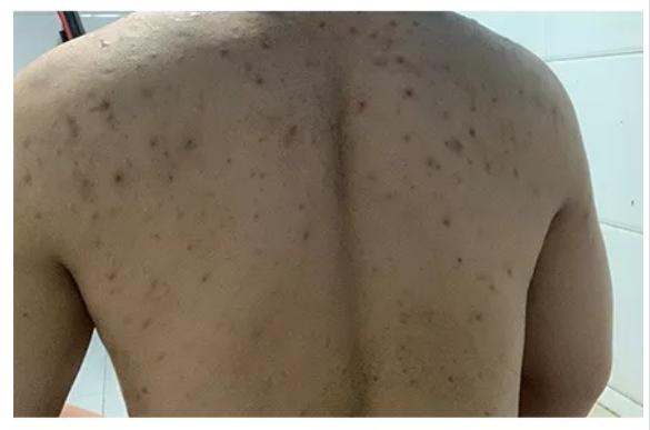 前胸后背的痘疤怎么去除,前胸后背长痘涂什么药膏