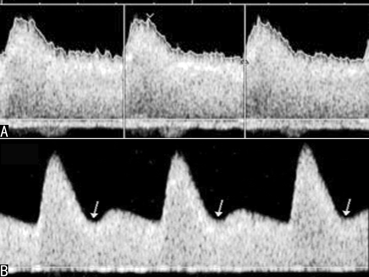 明明白白做超声23-2:妊娠期子宫及卵巢超声多普勒检查