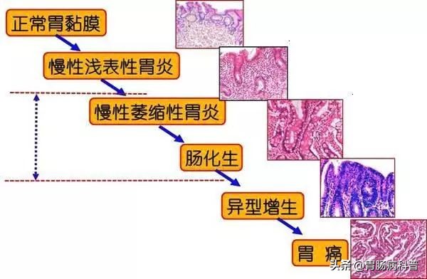 萎缩性胃炎伴肠化根本就治不好,萎缩性胃炎伴肠化可以根治吗