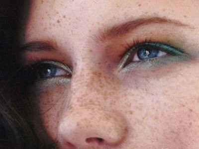 去除褐斑的方法,如何去除褐青色斑