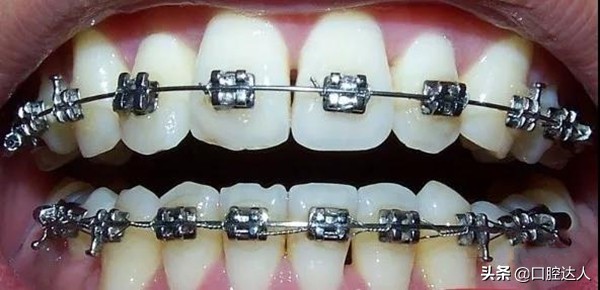 40多岁下排牙齿不齐有必要矫正吗,下排牙齿不齐切片局部矫正