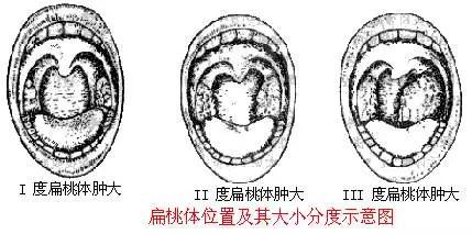 嗓子疼，喝口水都痛？那是因为这个器官出了问题
