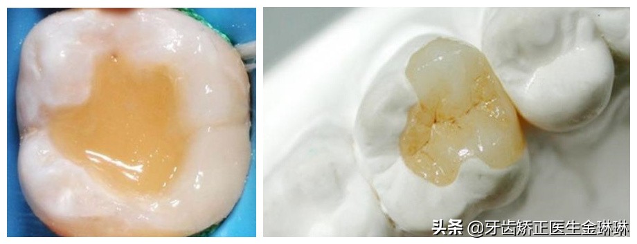 补牙材料银汞吃下去了要紧吗,补牙的银汞材料边缘掉了一点