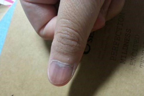 左手大拇指指甲上有褐色的竖纹,指甲上有竖纹代表有糖尿病吗