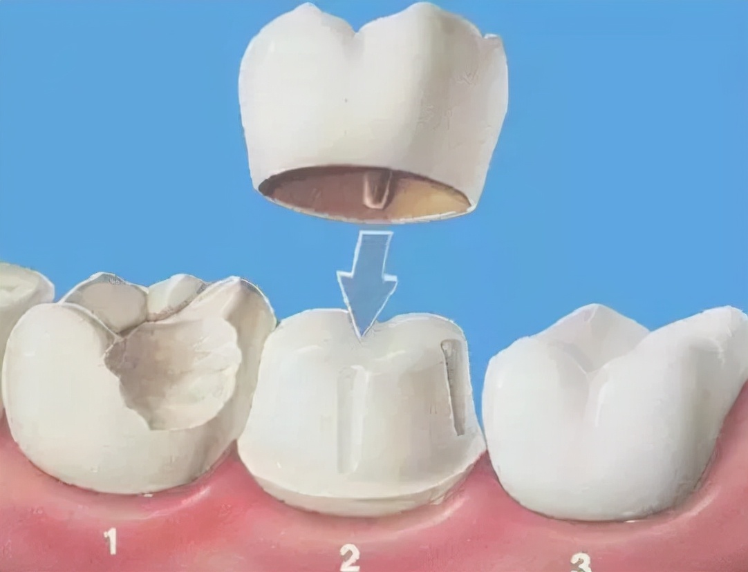 根管治疗后戴牙冠有后悔的吗,做完根管治疗不戴牙冠和戴了区别