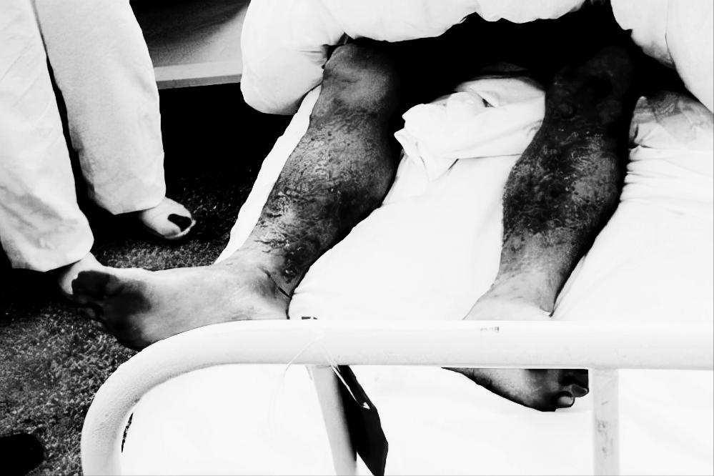 日军遗留芥子气毒剂泄漏事件,芥子气对日军的伤亡